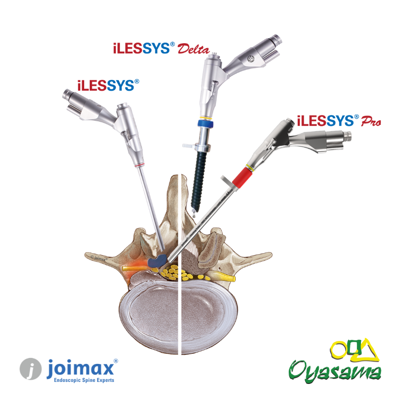 Ilustración-abordajes-endoscopia-joimax
