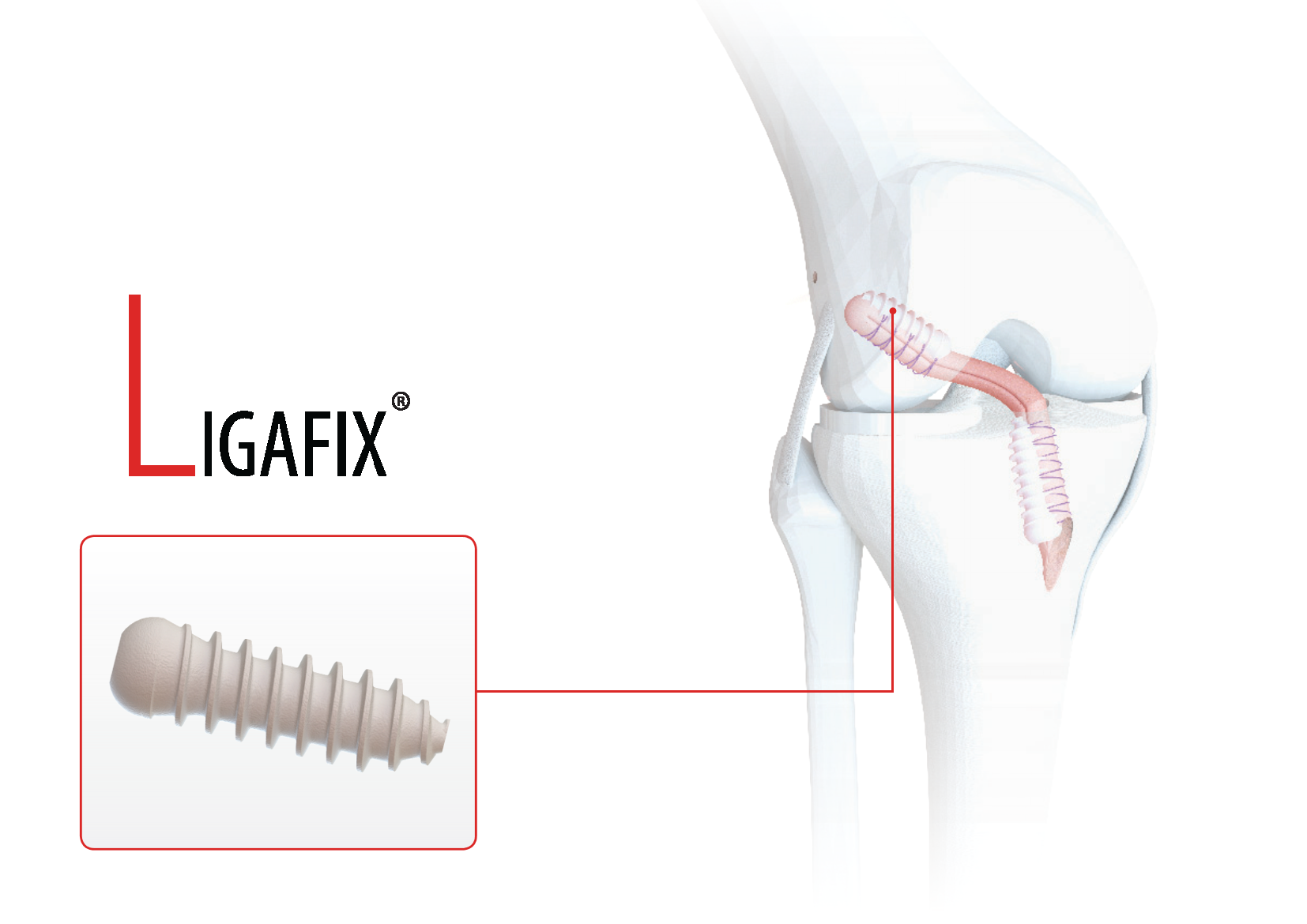 tornillo de fijación interferencial reabsorbible para artroscopia de rodilla