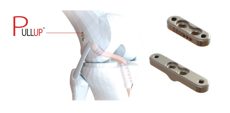 Solución para fijación femoral en reparación de ligamentos de rodilla. Idóneo para la reconstrucción de Ligamento Cruzado Anterior