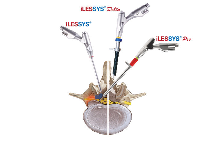 Sistema de endoscopia de columna iLESSYS® para acceso interlaminar