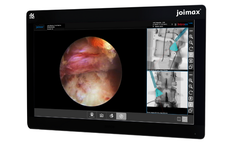 monitor médico de alta definición del sistema de endoscopia de columna de Joimax