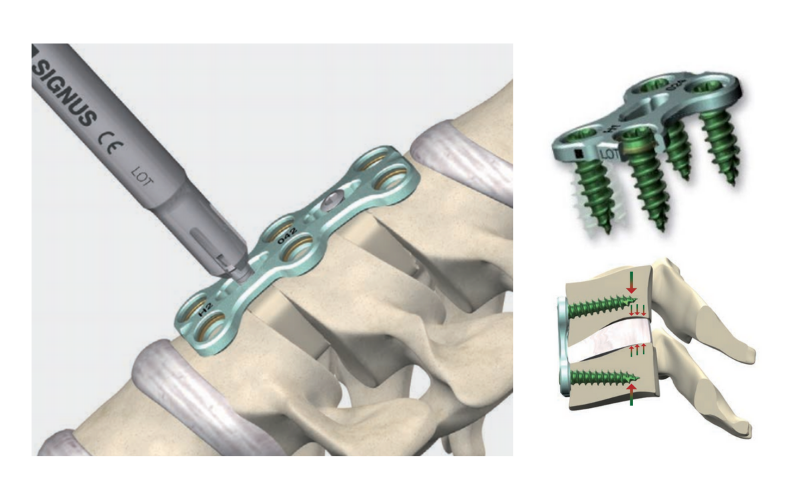 Sistema de placa y tornillos ASCOT® para estabilización temporal de la columna vertebral a nivel cervical