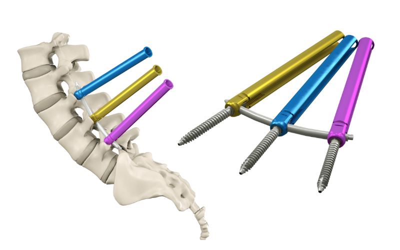 sistema de fijación vertebral mínimamente invasivo